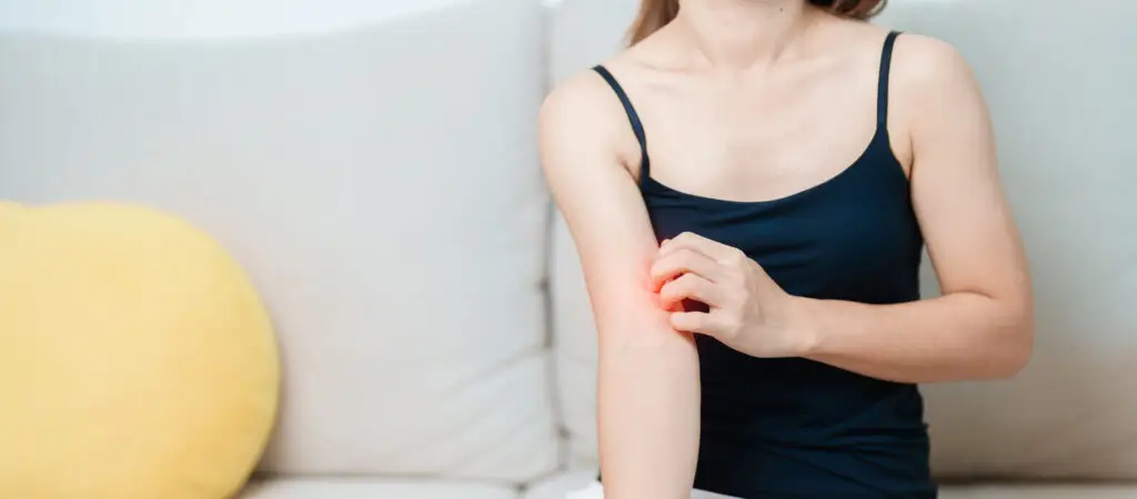 woman itching and scratching itchy arm. Sensitive Skin Allergic reaction to insect bite, food, drug dermatitis. Dermatology, Leprosy day, Systemic lupus erythematosus, Allergy symptoms and rash Eczema